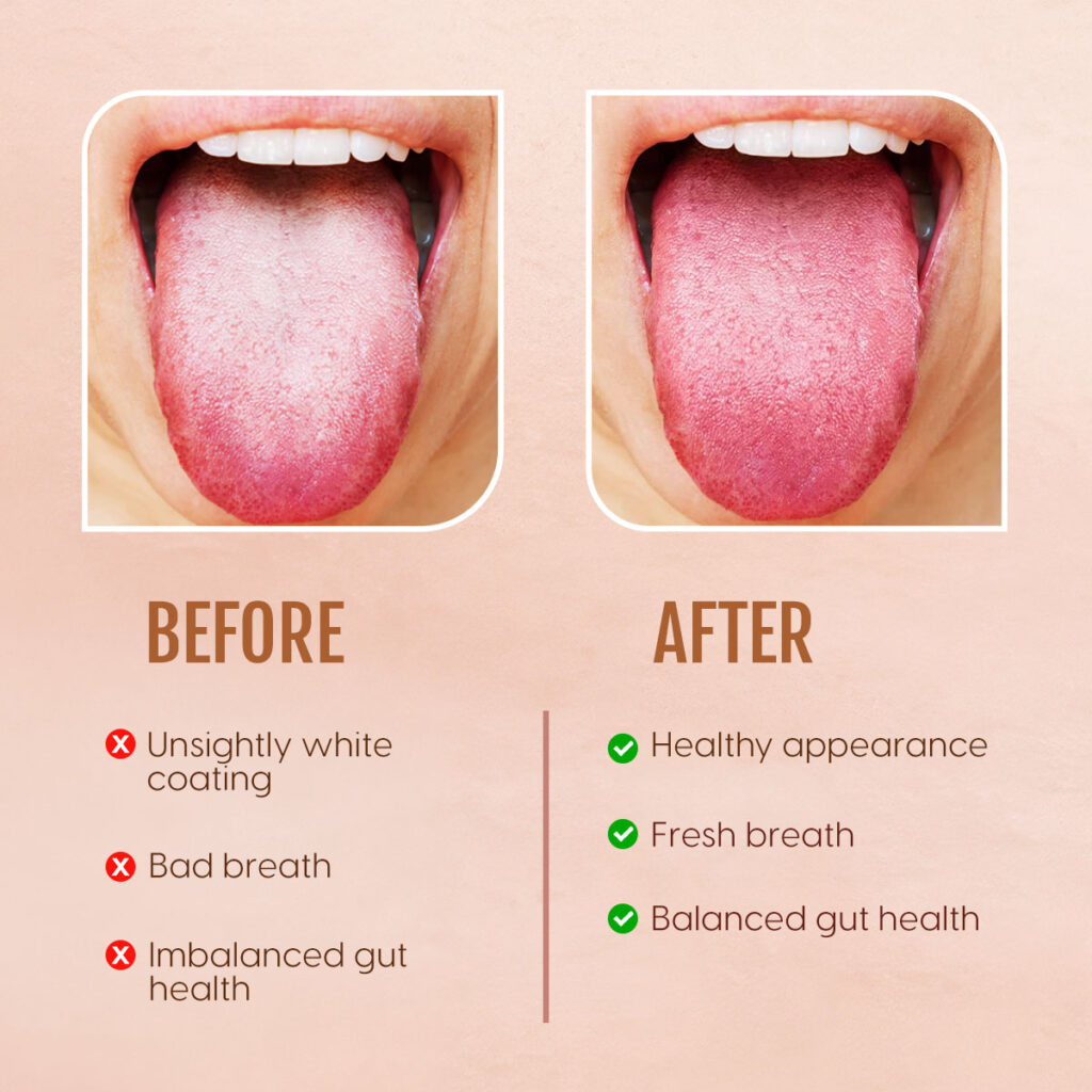 清潔前後舌苔效果對比示意圖